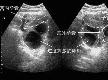 做了结扎手术可以在武穴市试管医院做试管婴儿吗？费用是多少